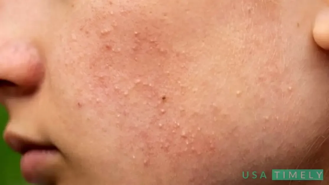 What Causes Milialar & How To Prevent It?